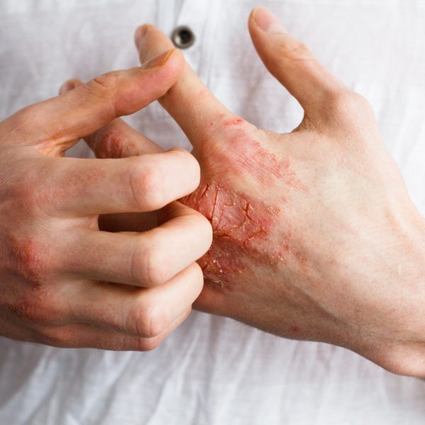 causes-of-eczema-scaled